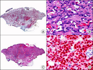 Angiosarcoma afectando la piel de la mama posradioterapia por cáncer de mama. A. Visión panorámica (x10). B. Vasos irregulares tapizados por células endoteliales atípicas (x400). C. El mismo caso estudiado inmunohistoquímicamente para la amplificación del gen c-Myc (x10). D. Intensa positividad de c-Myc en la mayoría de los núcleos de las células neoplásicas (x400).