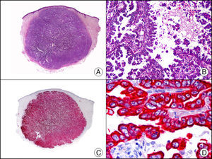 Metástasis cutánea de carcinoma papilar de endometrio. A. Visión panorámica (x10). B. Detalle a gran aumento mostrando papilas tapizadas por células epiteliales atípicas (x200). C. El mismo caso estudiado inmunohistoquímicamente con citoqueratinas 8/18 (x10). D. Detalle de la positividad para citoqueratinas 8/18 de las células neoplásicas (x400).