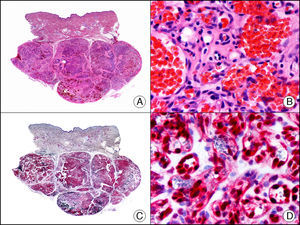 Hemangioma capilar lobulillar. A. Visión panorámica (x10). B. Detalle de los capilares tapizados por células endoteliales que constituyen la lesión (x400). C. El mismo caso estudiado inmunohistoquímicamente con ERG (x10). D. Detalle de la positividad para el ERG en el núcleo de las células endoteliales proliferantes (x400).