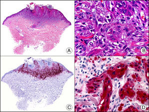 Nevo de Spitz. A. Visión panorámica (x10). B. Detalle de los melanocitos con núcleo vesiculoso, nucléolo prominente y citoplasma amplio y eosinófilo (x400). C. El mismo caso estudiado inmunohistoquímicamente con proteína S100 (x10). D. Intensa positividad de los melanocitos neoplásicos para la proteína S100 (x400).