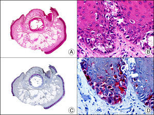 Melanoma subungueal in situ. A. Visión panorámica (x10). B. A mayor aumento se observan numerosos melanocitos de núcleo pleomórfico e hipercromático salpicados en las hileras basal y suprabasales del epitelio (x400). C. El mismo caso estudiado inmunohistoquímicamente con Melan A (x10). D. Detalle de la positividad para Melan A de los melanocitos neoplásicos (x400).