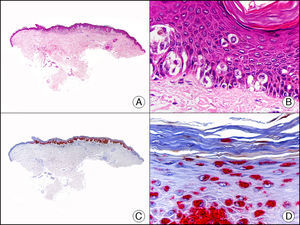 Melanoma in situ. A. Visión panorámica (x10). B. Melanocitos pagetoides salpicando como células aisladas las capas basal y suprabasal de la epidermis (x200). C. El mismo caso estudiado inmunohistoquímicamente con HMB-45 (x10). D. Intensa positividad para el HMB45 de los melanocitos neoplásicos salpicando capas altas de la epidermis (x200).