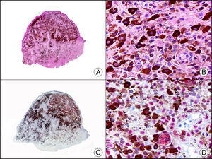 Nevo azul de células epitelioides. A. Visión panorámica (x10). B. Células epitelioides con citoplasma amplio y conteniendo abundante pigmento melánico (x400). C. El mismo caso estudiado inmunohistoquímicamente con MiTF-1 (x10). D. Detalle de la positividad nuclear para MiTF-1 de los melanocitos epitelioides, mientras que el núcleo de los melanófagos resulta negativo (x400).