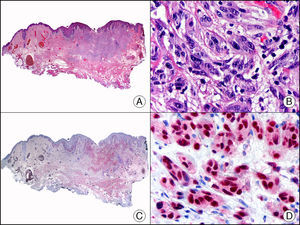 Melanoma desmoplásico. A. Visión panorámica (x10). B. Detalle de los melanocitos neoplásicos en la dermis reticular (x400). C. El mismo caso estudiado inmunohistoquímicamente con Sox 10 (x10). D. Detalle de la positividad nuclear para Sox 10 de los melanocitos neoplásicos de la dermis (x400).