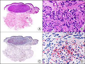 Neuroma encapsulado en empalizada. A. Visión panorámica (x10). B. Detalle de las células neoplásicas de núcleo fusiforme (x400). C. El mismo caso estudiado inmunohistoquímicamente con neurofilamentos (x10). D. Detalle de la positividad para neurofilamentos de los axones de las fibras nerviosas proliferantes (x400).
