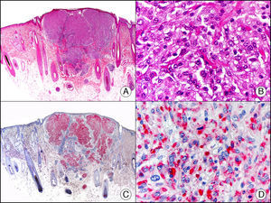 Neurotecoma celular. A. Visión panorámica (x10). B. Detalle de las células neoplásicas mostrando un núcleo vesiculoso y citoplasma eosinófilo (x400). C. El mismo caso estudiado con PGP 9.5 (x10). D. Detalle de la positividad para PGP 9.5 de las células neoplásicas (x400).