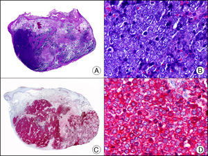 Tumor de Merkel. A. Visión panorámica (x10). B. Detalle de las células neoplásicas mostrando un núcleo redondo con cromatina granular y numerosas imágenes de mitosis (x400). C. El mismo caso estudiado inmunohistoquímicamente con enolasa neuronal específica (x10). D. Positividad de las células neoplásicas para la enolasa neuronal específica (x400).