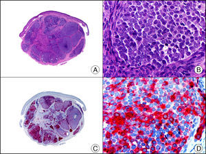 Tumor de Merkel. A. Visión panorámica (x10). B. Detalle de las células neoplásicas mostrando un núcleo redondo con cromatina granular (x400). C. El mismo caso estudiado inmunohistoquímicamente con cromogranina (x10). D. Positividad de las células neoplásicas para la cromogranina (x400).
