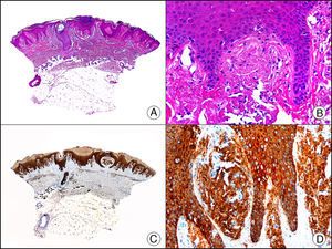 Liquen amiloide. A. Visión panorámica (x10). B. Detalle mostrando hiperplasia de la epidermis y depósitos de sustancia amiloide en la dermis papilar (x200). C. El mismo caso teñido con citoqueratina 903. Obsérvese la positividad tanto de la epidermis como de la sustancia amiloide de la dermis papilar, demostrando su origen epitelial (x10). D. Detalle de la sustancia amiloide en la dermis papilar con positividad de la citoqueratina 903 (x200).
