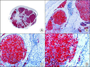 El mismo caso de la figura anterior estudiado inmunohistoquímicamente con sinaptofisina (A x10, B x40, C x200, D x400).