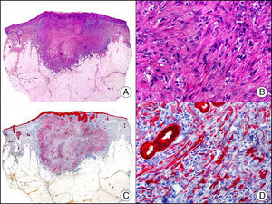 Carcinoma espinocelular muy indiferenciado con apariencia sarcomatoide. A. Visión panorámica (x10). B. Detalle de las células neoplásicas mostrando una morfología fusocelular y sin evidencia de queratinización (x400). C. El mismo caso estudiado inmunohistoquímicamente con pancitoqueratina MNF116. Obsérvese la positividad de la epidermis y del epitelio de los anejos de la dermis como control positivo interno (x10). D. A gran aumento, se observa cómo, además de los ductos ecrinos, algunas células neoplásicas expresan positividad para la pancitoqueratina MNF116 en su citoplasma (x400).