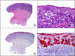 Metástasis epidermotropa de carcinoma de vejiga en la mucosa del glande simulando enfermedad de Paget extramamaria. A. Visión panorámica (x10). B. A mayor aumento se observan células grandes de núcleo pleomórfico y citoplasma amplio salpicadas por todo el espesor del epitelio (x400). C. El mismo caso estudiado inmunohistoquímicamente con citoqueratina 7 (x10). D. A mayor aumento, se observa cómo las células neoplásicas intraepiteliales expresan citoqueratina 7 (x400).