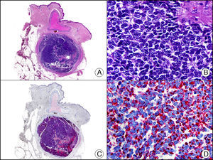 Tumor de Merkel. A. Visión panorámica (x10). B. Características citológicas de las células neoplásicas a gran aumento mostrando su núcleo redondo y basófilo, con cromatina granular y sin nucléolo y escaso citoplasma (x400). C. El mismo caso estudiado inmunohistoquímicamente con citoqueratina 20 (x10). D. Detalle a gran aumento de la positividad en el glóbulo paranuclear para la citoqueratina 20 en las células neoplásicas (x400).