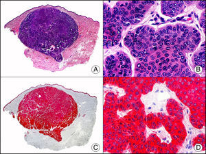 Carcinoma basocelular. A. Visión panorámica (x10). B. A mayor aumento se observan islotes de células basaloides (x400). C. El mismo caso estudiado inmunohistoquímicamente con citoqueratina 14 (x10). D. Detalle de la positividad para la citoqueratina 14 de las células neoplásicas (x200).