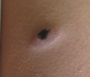Asymmetric pigmented nodule (1cm×2cm) on the left anterior thigh.