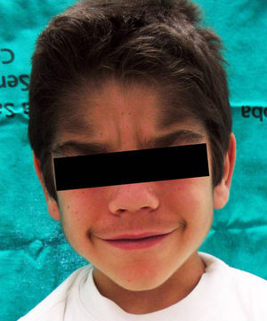 Hipertricosis de predominio en regiones temporales, cejas y labio superior.