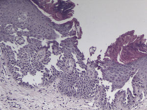 Ligera hiperplasia epidérmica con hiperqueratosis, paraqueratosis, acantosis, acantólisis focal con hendiduras suprabasales (hematoxilina-eosina x 40).
