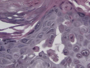 Hematoxilina-eosina (x 63): disqueratosis con cuerpos redondos y granos.