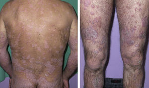 Placas eritematodescamativas generalizadas previas al inicio del tratamiento con etanercept.