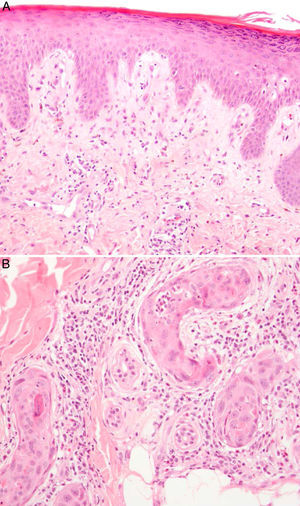 A) Hiperqueratosis y acantosis irregular. Signos de dismaduración epidérmica: células disqueratósicas, con alteración del tamaño y la polaridad de los queratinocitos, algunos de ellos binucleados (HE×10). B) Conductos ecrinos en los que se observan zonas de metaplasia escamosa junto con infiltrado neutrofílico en el interior de los ovillos, así como un moderado infiltrado inflamatorio periecrino (HE×40).