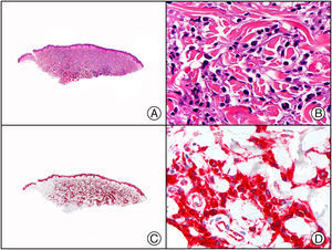 Infiltración cutánea específica por mieloma múltiple. A) Visión panorámica. B) Detalle de las células plasmáticas neoplásicas. C) El mismo caso estudiado inmunohistoquímicamente con CD38. D) Positividad de las células plasmáticas neoplásicas para CD38.