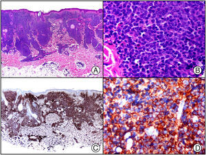 Infiltración cutánea por leucemia mieloide crónica. A) Visión panorámica. B) Detalle de las células mieloides infiltrando la dermis. C) El mismo caso estudiado inmunohistoquímicamente con CD45. D) Detalle de la positividad de las células neoplásicas para CD45.