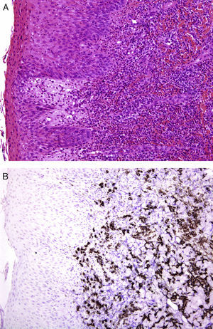 A. Erupción liquenoide en un niño con características clínicas de PLEVA que histológicamente muestra atipia linfocitaria. (HE × 200.) B. Contiene abundantes células linfoides CD30+. (CD30 [inmunohistoquímica] × 200.)
