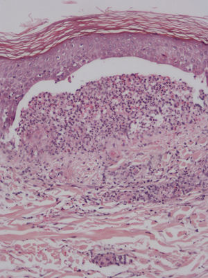 Despegamiento dermo-epidérmico con infiltrado inflamatorio rico en neutrófilos (hematoxilina-eosina x10).