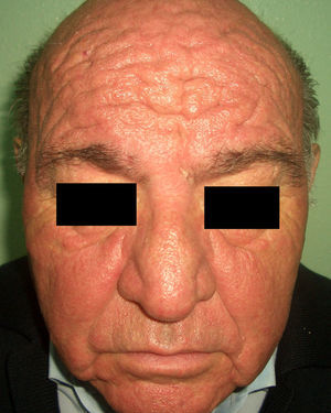 Síndrome carcinoide (facies leonina).