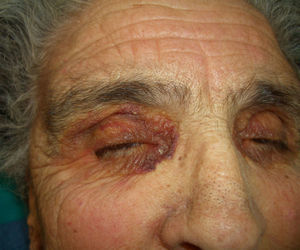 Amiloidosis sistémica primaria (púrpura periocular).