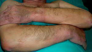 Escleromixedema (pápulas céreas en extremidades superiores).