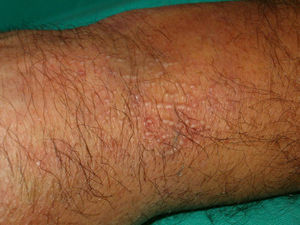 Detalle de la figura 11 (escleromixedema).