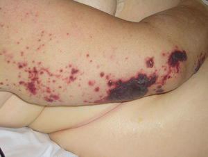 Púrpura y equimosis.