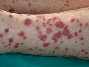 Vasculitis leucocitoclástica (púrpura palpable).