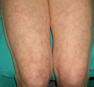 Livedo reticularis.