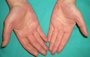 Eritema palmar.