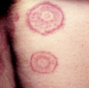 Eritema gyratum repens (anillos concéntricos).