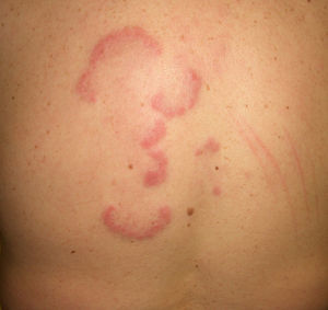 Eritema anular centrífugo (lesiones arciformes en el tronco).