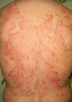 Lupus subagudo (lesiones anulares en la espalda).