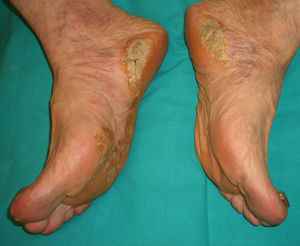Acroqueratosis paraneoplásica de Bazex (hiperqueratosis plantar y distrofia ungueal).