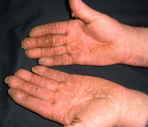 Queratodermia palmar.