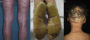 Características clínicas de la IL. A.Descamación laminar marronácea. B. Marcada hiperqueratosis plantar. C. Alopecia cicatricial en el cuero cabelludo.