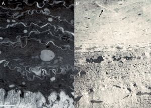 Imágenes de microscopía electrónica. A.Ictiosis congénita tipo 1 mostrando gotas lipídicas en el estrato córneo y ausencia de marcadores ultraestructurales de los demás tipos de ictiosis. B.Ictiosis congénita tipo 2 caracterizada por la presencia de cristales de colesterol (flecha) en los corneocitos.