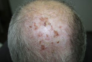 Lesiones de DPECC activas junto con queratosis actínicas.