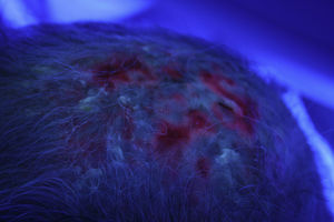 Intensa captación en la zona, tanto por las QA como por las lesiones de DPECC.