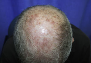 Nótese la mejoría tras 2 sesiones de TFD.