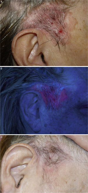 A) Placa eritematosa de 5cm de tamaño, con pigmentación lineal en la periferia localizada en área temporal derecha, que se extiende hacia piel preauricular no pilosa. B) Placa de fluorescencia roja intensa tras las 3h de incubación con metil-aminolevulinato. C) Remisión completa pasados 2 meses tras la segunda sesión de terapia fotodinámica.