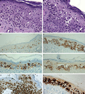 A y B) Imagen histológica de la lesión. Se observan las células claras que aisladamente ocupan la epidermis (H-E ×400). C) Expresión nuclear de receptores de estrógeno en las células atípicas (×200). D) Intensa tinción de membrana para Her2/neu (×200). E) Las células tumorales intraepidérmicas resultan positivas con CEA (×200). F) Se observa tinción citoplasmática para MUC-1 (×200). G) Expresión citoplasmática para citoqueratina 7 (×200). H) Resulta positivo el GCDFP-15 en el EPEM (×200).