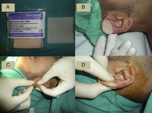 A. Tablilla termoplástica de grosor 1,6mm antes de colocar en recipiente con agua caliente. B. Tablilla recortada ajustándola al tamaño. C. Colocación de la tablilla a un lado y al otro del pabellón auricular; compresión manual durante unos segundos hasta la solidificación de la tablilla a modo de férula. D. Sutura transpabellón auricular, a un lado y al otro a modo de botón.