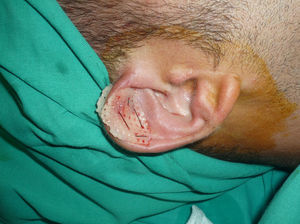 Resultado final tras la fijación de la tablilla a ambos lados del pabellón auricular.